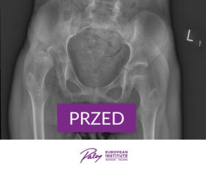 Podwichnięcie w stawie biodrowym przed operacją