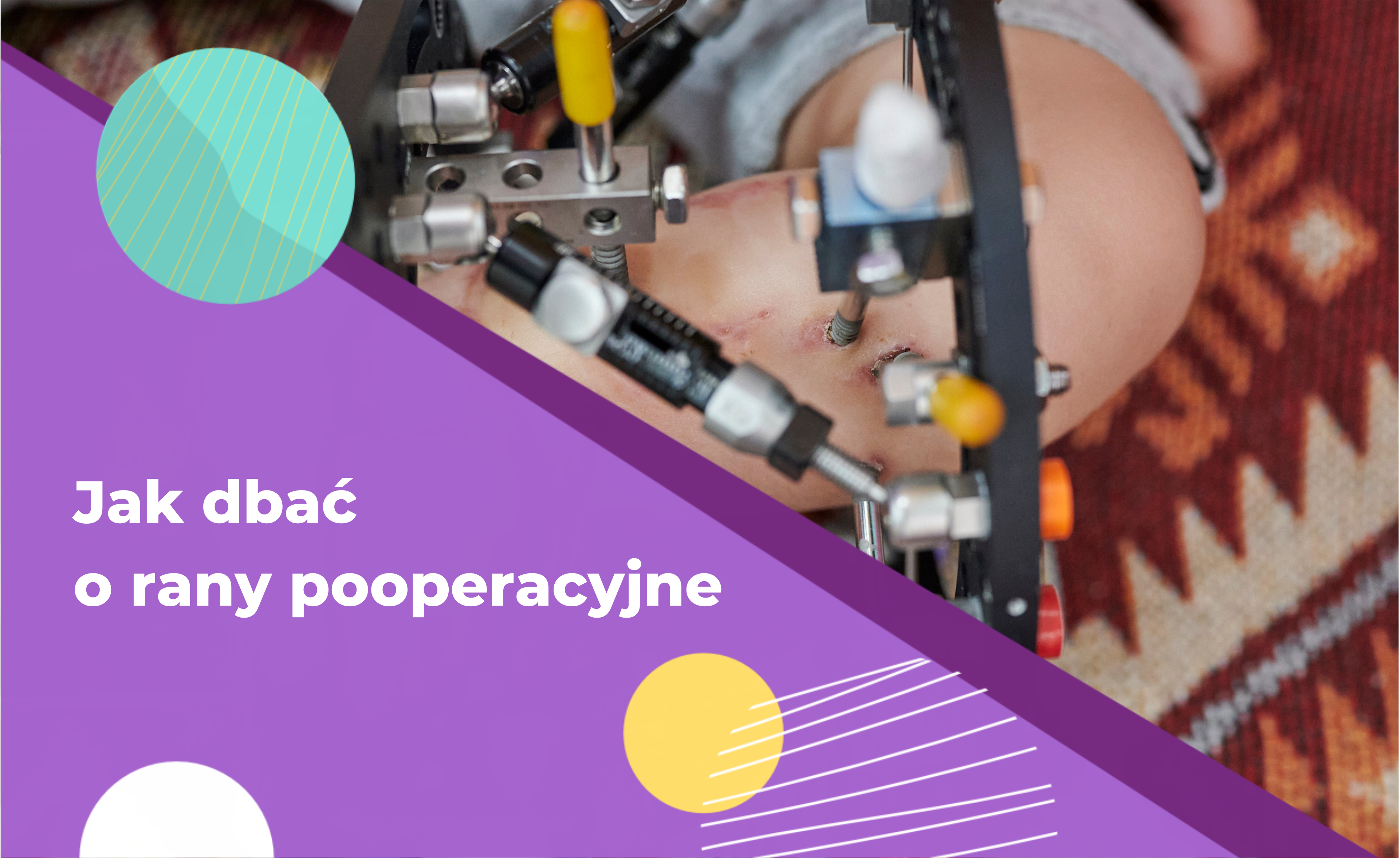 obrazek do artykuł€ Jak dbać o rany pooperacyjne: Kompletny przewodnik